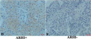 JMJD2A contributes to breast cancer progression through transcriptional repression of the tumor suppressor ARHI.